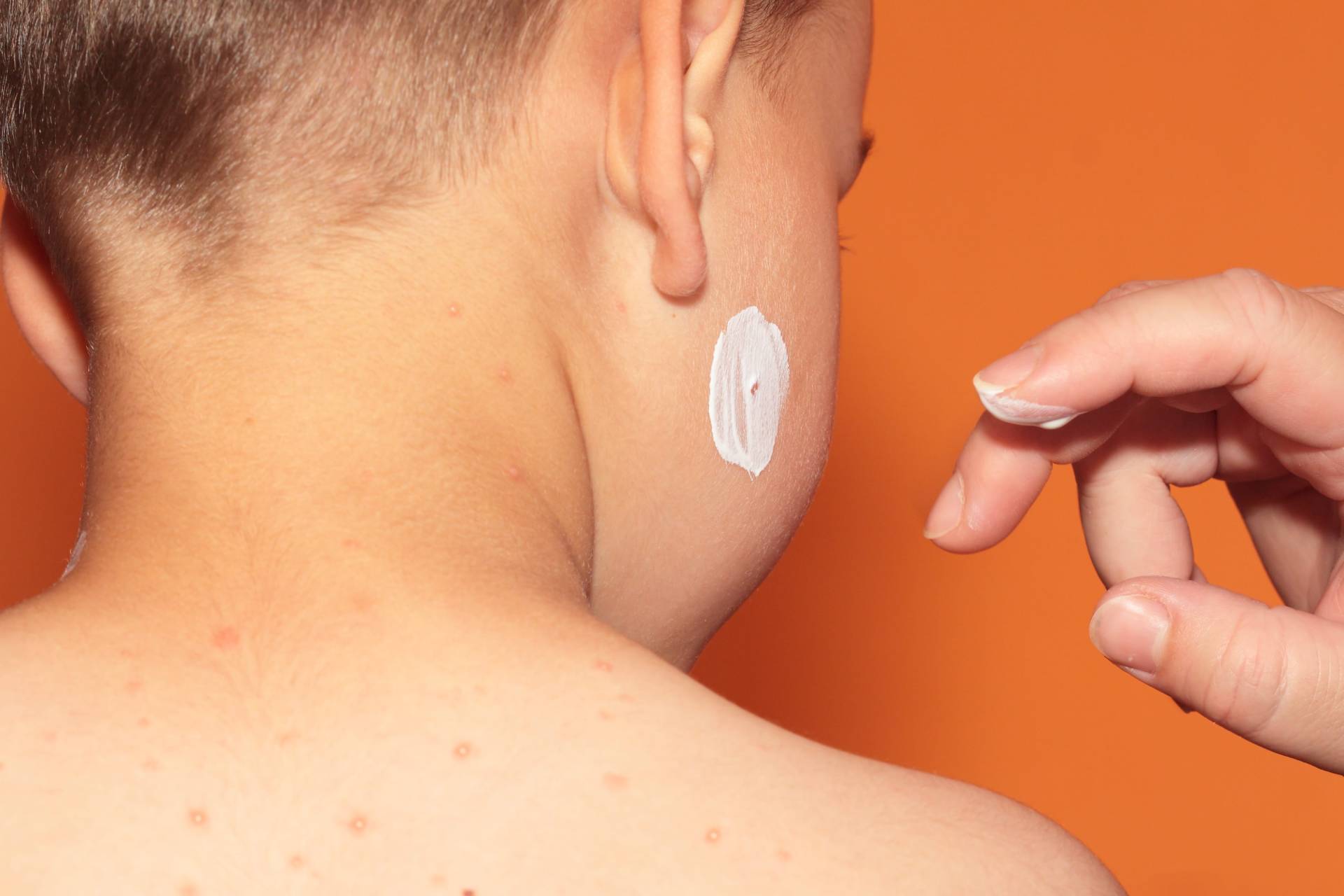 Are chicken pox parties safe?